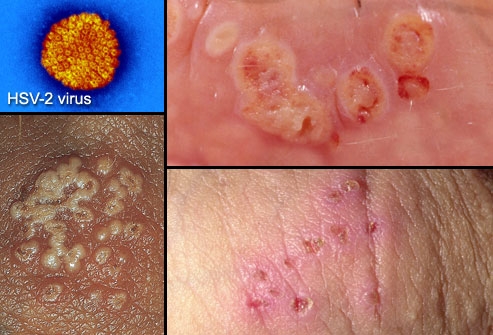 Bestie Herpes 2