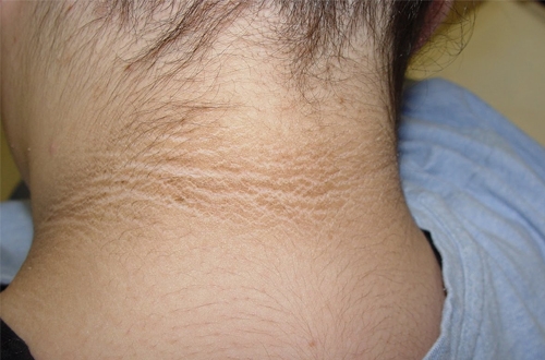 Bestie acanthosis nigricans