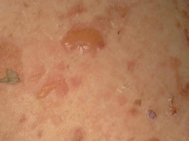 Bestie Pemphigus
