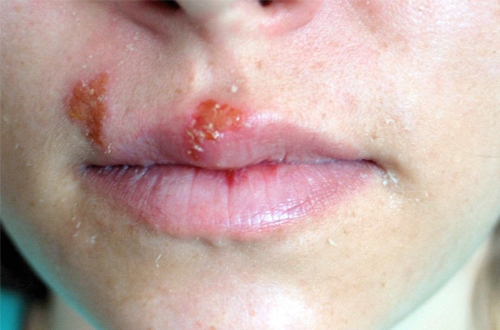 Bestie virus herpes