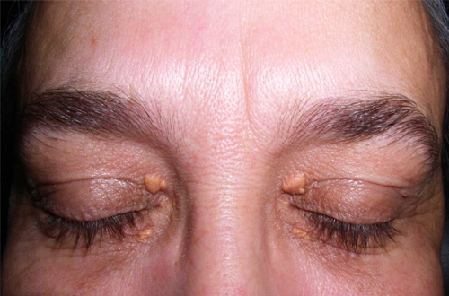 Bestie xanthelasma