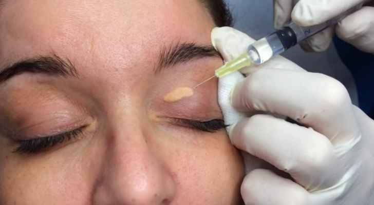 Bestie xanthelasma