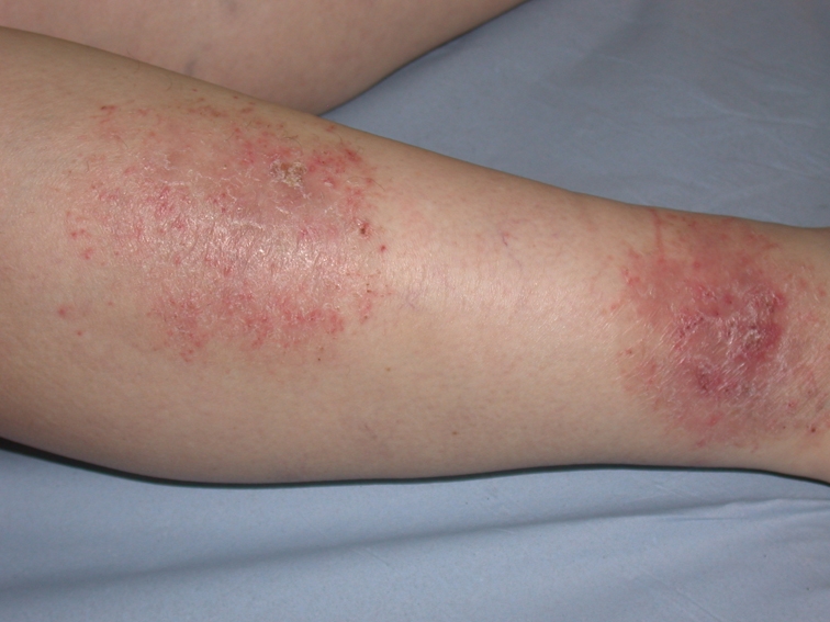 Bestie eczema