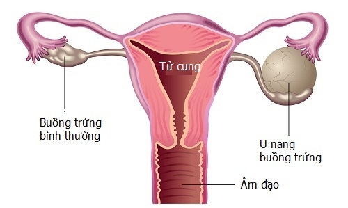 Thiếu nữ mang tiếng chửa hoang đến tận lúc qua đời vì căn bệnh quái ác