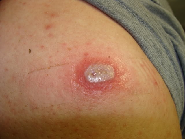 Bestie vaccine dau mua