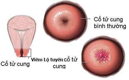 Bestie viem lo tuyen co tu cung