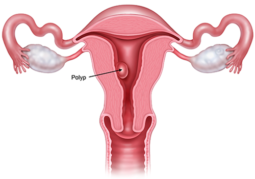 Bestie polyp tu cung