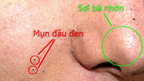 bestie phan biet mun dau den va soi ba nhon 1