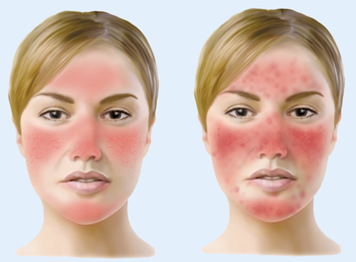 Bestie benh Rosacea