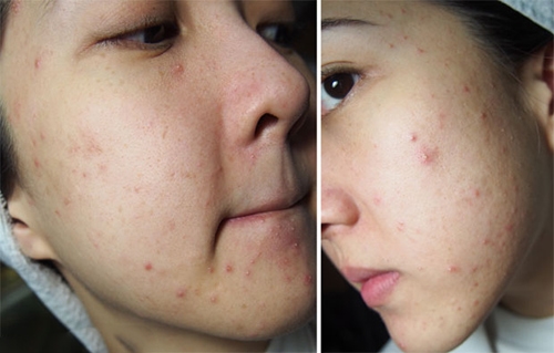 Thoa vaseline liên tục, vậy bạn có biết các tác hại của nó?