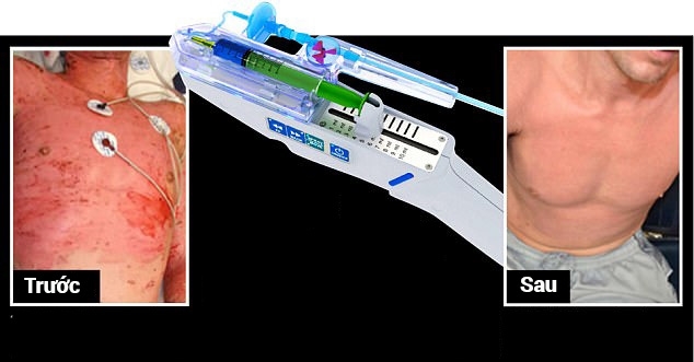 Chả cần cấy ghép da nữa, cách này sẽ giúp da mọc nhanh và không bị sẹo