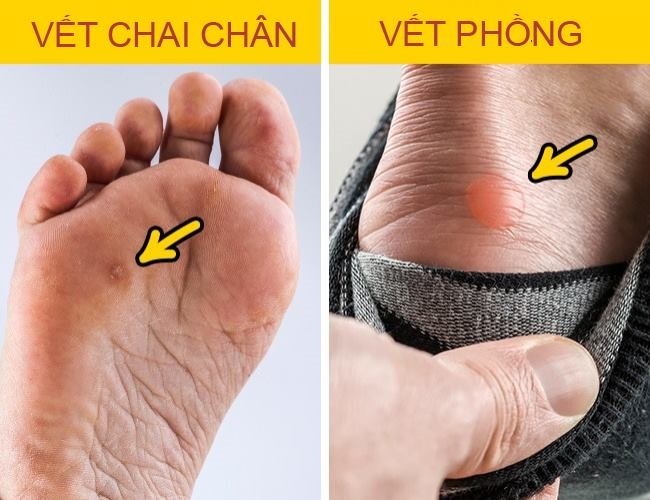 bestie chua vet chai chan phong rop