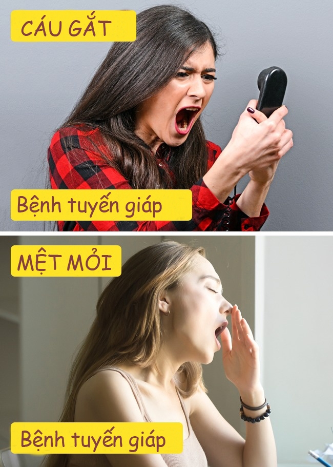 bestie benh tuyen giap