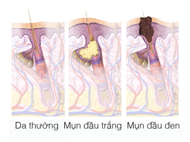 bestie phân biệt sợi bã nhờn và mụn đầu đen 2