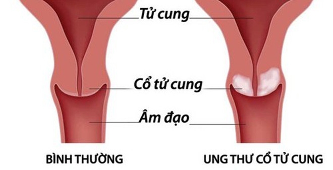 bestie ung thu co tu cung