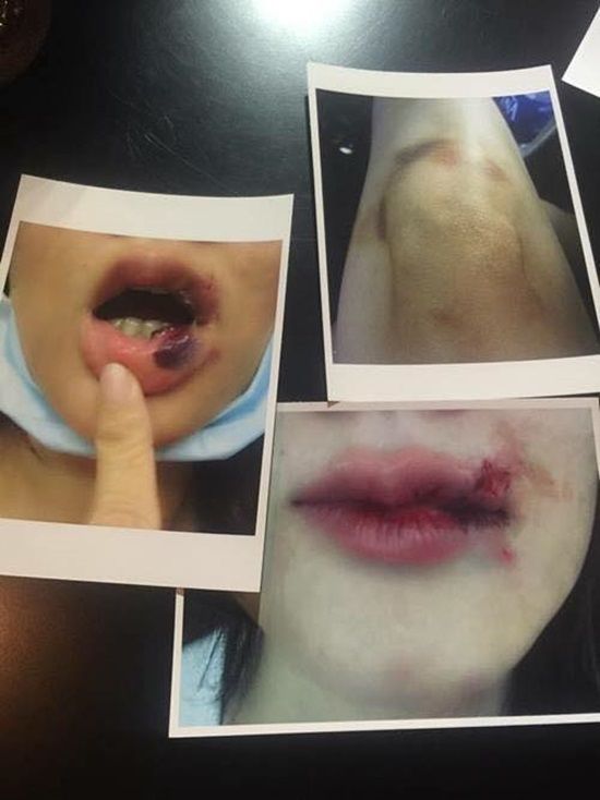 bestie sao viet bi nguoi thuong bao hanh