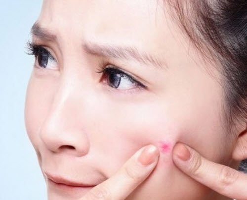 Mụn và những điều bạn cần biết về chúng