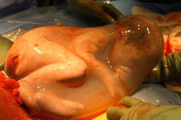Vì sao em bé sinh ra trong bọc điều được tin là sẽ gặp may mắn