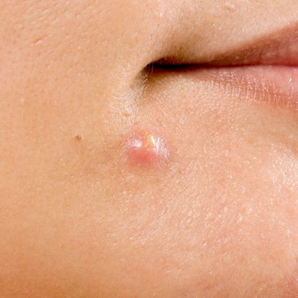 Mụn và những điều bạn cần biết về chúng