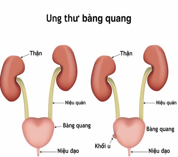 bestie-ung-thu-bang-quang