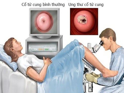 Các thói quen dễ gây ung thư cổ tử cung ở phái nữ
