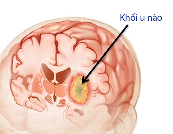 Dấu hiệu của bệnh ung thư não