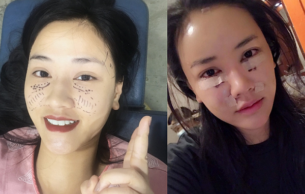 Nâng mũi, độn cằm sao nữ Việt còn chỉnh sửa bộ phận này mà ít ai để ý