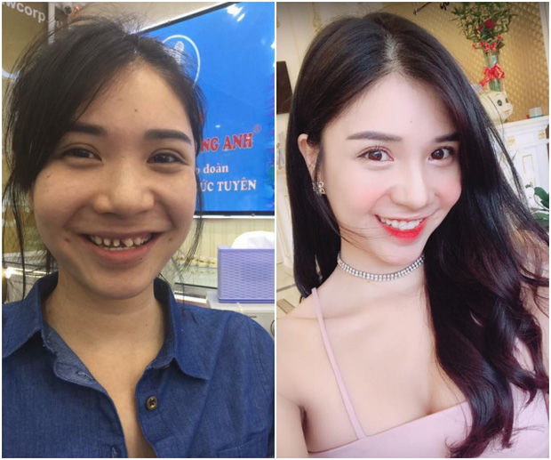 Nâng mũi, độn cằm sao nữ Việt còn chỉnh sửa bộ phận này mà ít ai để ý