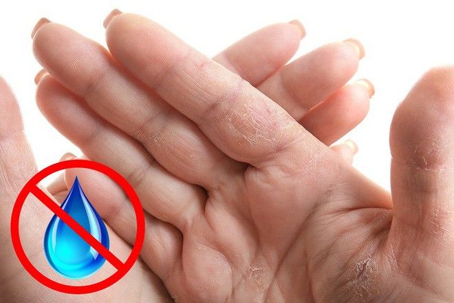 Những dấu hiệu cảnh báo bệnh nguy hiểm được biểu hiện qua đôi bàn tay