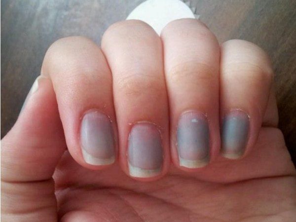 Những dấu hiệu cảnh báo bệnh nguy hiểm được biểu hiện qua đôi bàn tay