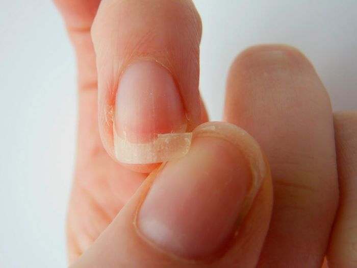 Những dấu hiệu cảnh báo bệnh nguy hiểm được biểu hiện qua đôi bàn tay