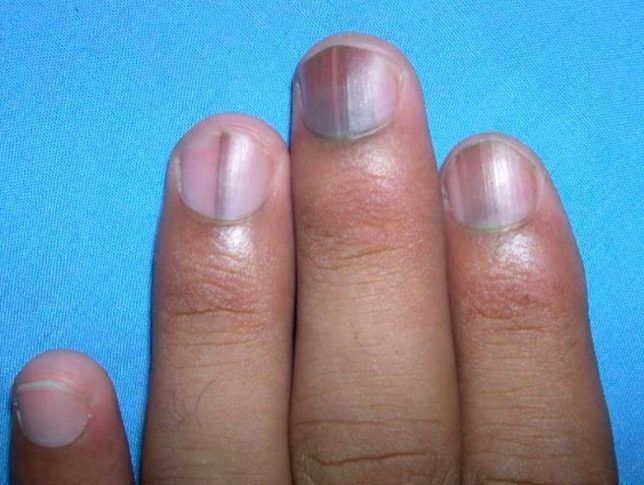 Những dấu hiệu cảnh báo bệnh nguy hiểm được biểu hiện qua đôi bàn tay