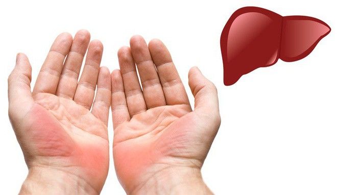 Những dấu hiệu cảnh báo bệnh nguy hiểm được biểu hiện qua đôi bàn tay