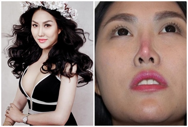 Những người đẹp showbiz lao đao vì hậu trùng tu nhan sắc hỏng