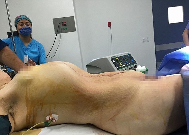 Cô gái mang trong mình khối u tương đương với 10 trẻ sơ sinh