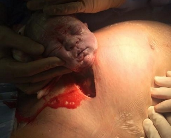 Cứ ngỡ sinh mổ là khỏe, xem những hình ảnh này mới thấu hiểu