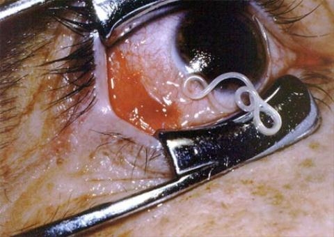 Sự thật kinh dị sau một cục u nhỏ tưởng vô hại trên mặt