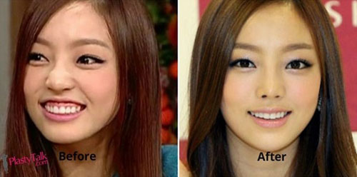 Thừa nhận dao kéo nhưng sự nghiệp của sao vẫn lên như diều gặp gió