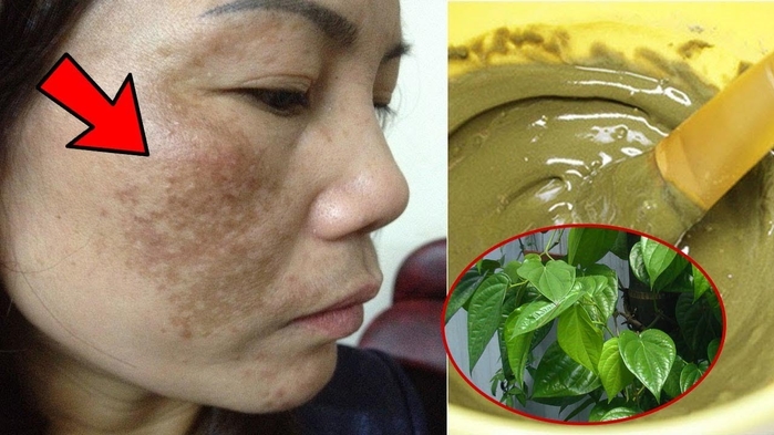 Bí quyết trị tàn nhang từ 9 nguyên liệu thiên nhiên quen thuộc