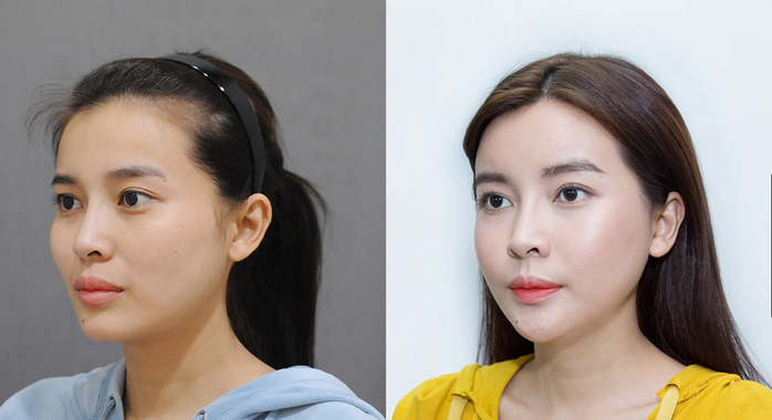 Cao Thái Hà bị đào mộ ảnh thời chưa thẩm mỹ