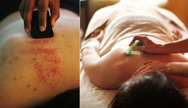 Những cách cạo gió tại nhà đơn giản mà cực kì công hiệu