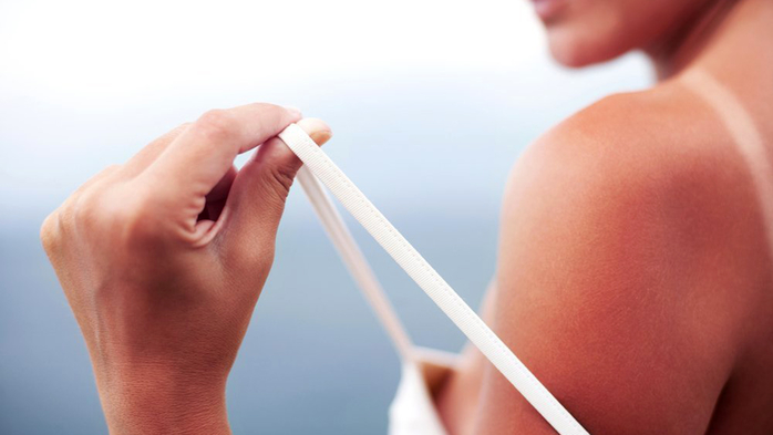 Mẹo giảm đau rát cho da gây ra bởi cháy nắng