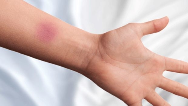 Những triệu chứng đông máu có thể dẫn đến đột quỵ không nên phớt lờ
