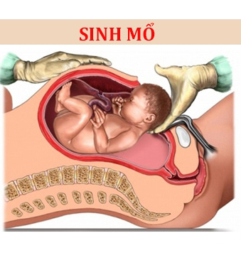 Tìm đáp án cho câu hỏi của không ít bà mẹ: sinh thường hay mổ tốt hơn?
