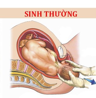 Tìm đáp án cho câu hỏi của không ít bà mẹ: sinh thường hay mổ tốt hơn?