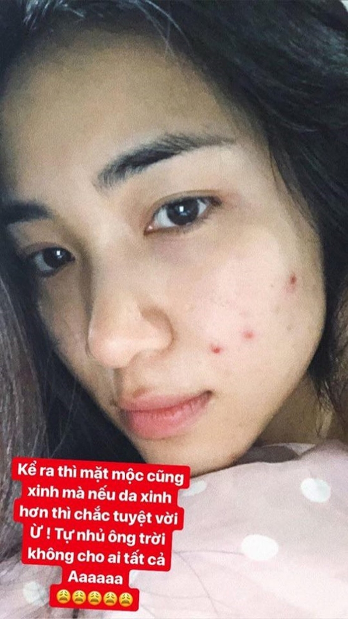 Những căn bệnh nghề nghiệp sao Việt phải chịu đựng