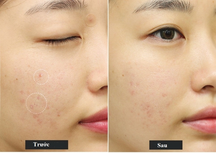 Cách nấu nước gạo lên men đúng chuẩn giúp da sạch mụn, trắng hồng