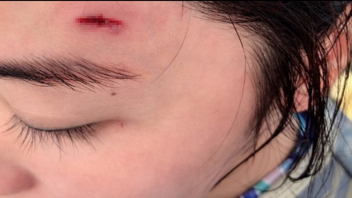 Chung Hân Đồng vừa rách đầu gối Thái Trác Nghiên đã bị thương đầu