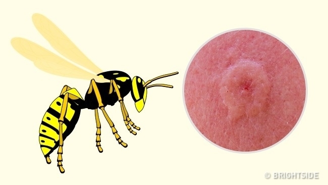 Nhận dạng vết cắn côn trùng nhanh chóng và cách giải quyết
