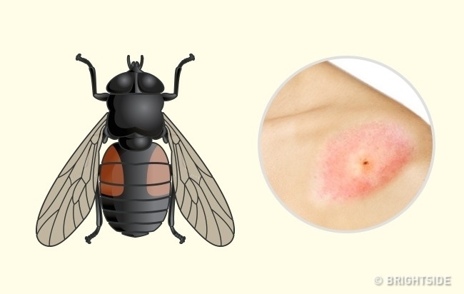 Nhận dạng vết cắn côn trùng nhanh chóng và cách giải quyết